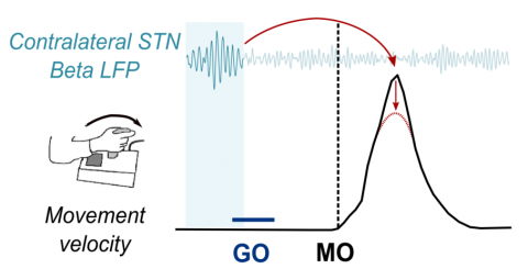 Bursts of beta activity (beta LFP) in the subthalamic nucleus (STN) approximately half a second before the movement onset (MO) are associated with lower speeds (velocity; red arrows) of the forthcoming reaching movements.