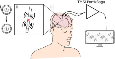 diagram of the deep brain stimulation recording electrode with four contacts and the output to TMSi Porti/Saga