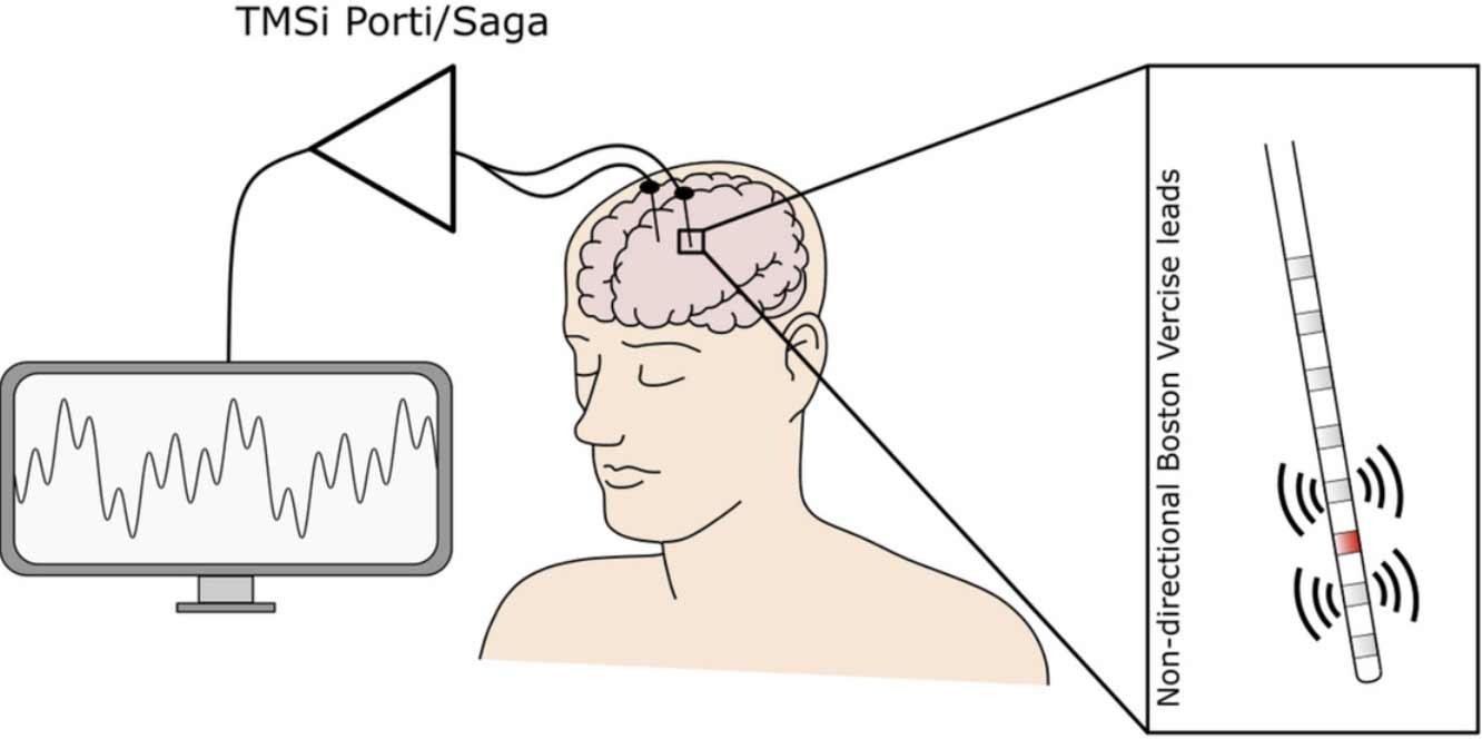 Diagram of a human torso with two deep brain electrodes, showing No-direction Boston Vercise leads in close-up