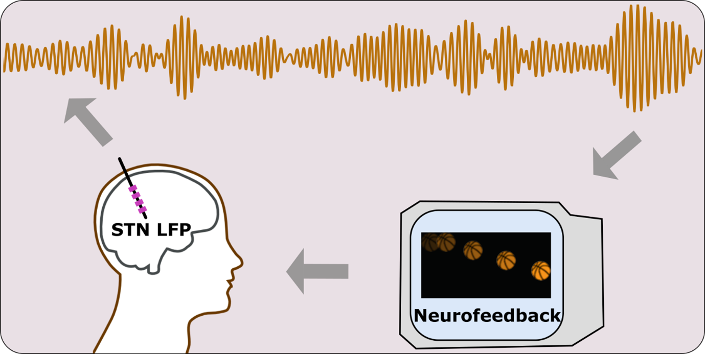 Diagram showing head in profile, with Electrophysiology trace above, as the output from a DBS electrode recording, and neurofeedback on a display shown to the person.